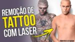 REMOÇÃO DE TATTOO A LASER: Como Funciona? 6 Perguntas Respondidas sobre o assunto – #TattooMM