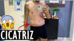VLOG – COMO FICOU A CICATRIZ DA CIRURGIA? | Menino Prendado