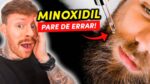 4 GAFES ao usar MINOXIDIL que podem DESTRUIR o TRATAMENTO (e você não sabia)