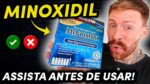 MINOXIDIL: MITOS e VERDADES sobre o Tratamento (Assista antes de Usar!)