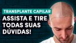 TRANSPLANTE CAPILAR: Falei com um MÉDICO pra tirar TODAS AS DÚVIDAS sobre o Tratamento | Técnica FUE