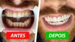 Meu NOVO SORRISO: Coloquei LENTES nos meus DENTES e contei TUDO sobre o PROCEDIMENTO