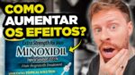 MINOXIDIL: 3 Maneiras de AUMENTAR os Efeitos do Tratamento