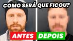 Fiz uma HARMONIZAÇÃO FACIAL! Como ficou o RESULTADO? Harmonização Facial Masculina
